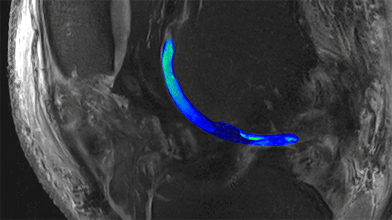 MRI tech reveals cartilage quality