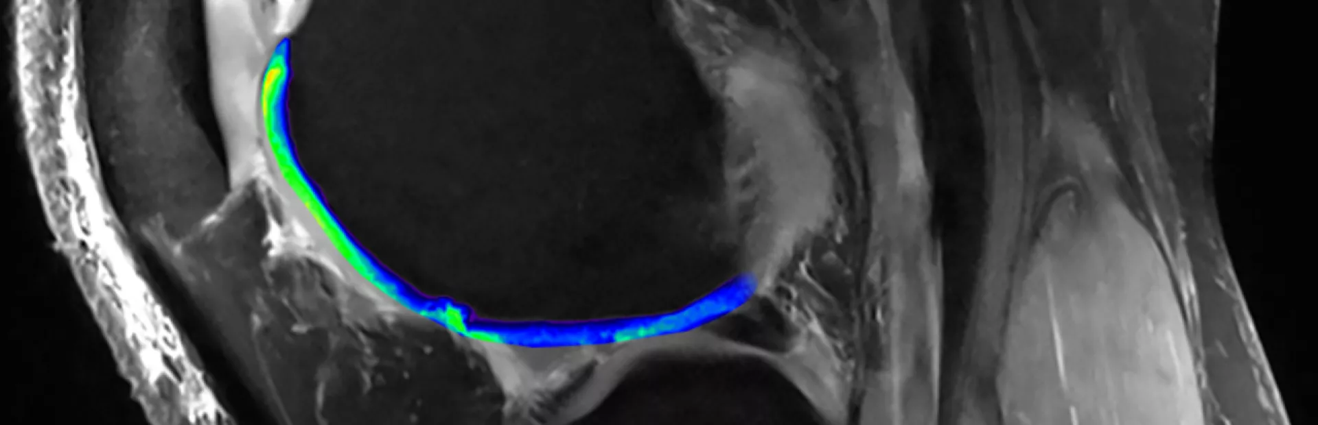 MRI technology reveals cartilage in knees