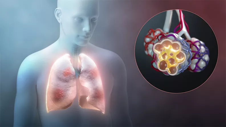 Immune reaction to COVID-19 can affect lungs.